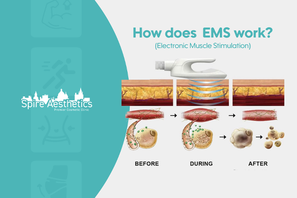 EMS treatment for post pregnancy weight loss treatment Southsea