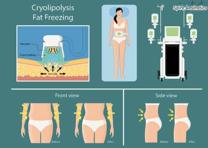 Image of diet and fat freezing combined for best results for Spire Aesthetics Southsea