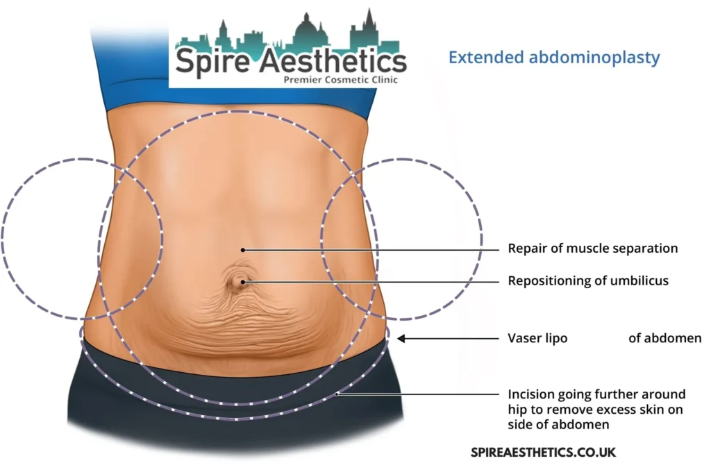 Understanding Loose Skin After Gastric Band Southsea Surgery and HIFU Treatment