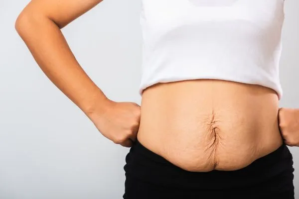 Image of a woman's stomach after weight loss with sagging skin following a gastric band Southsea