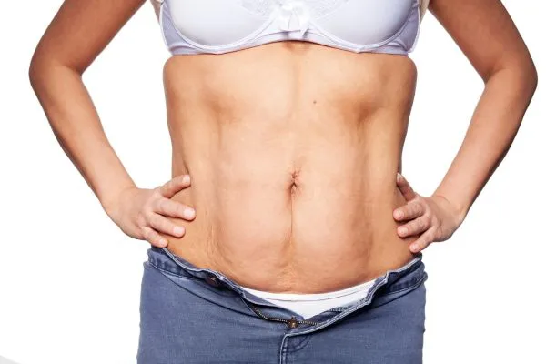 sagging skin on woman's stomach after weight loss injections Southsea
