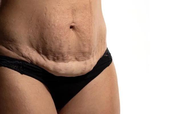 Image of womans stomach after weight loss injections Southsea showing saggy skin