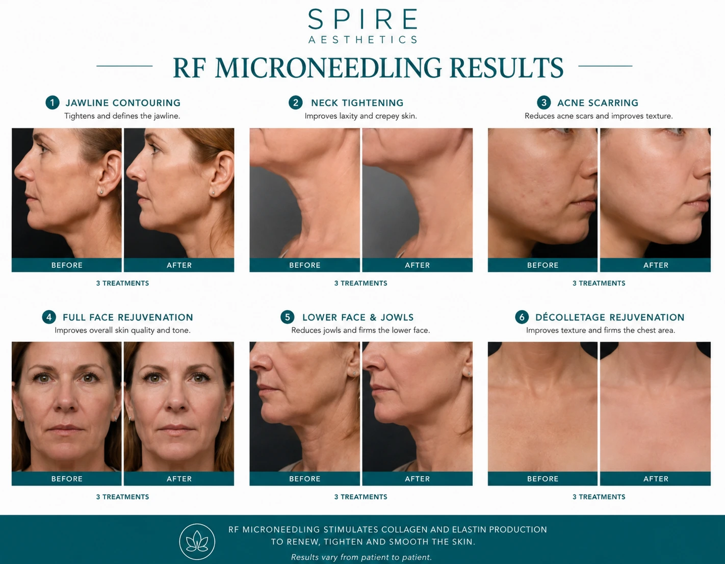 RF Microneedling Skin tightening Southsea results