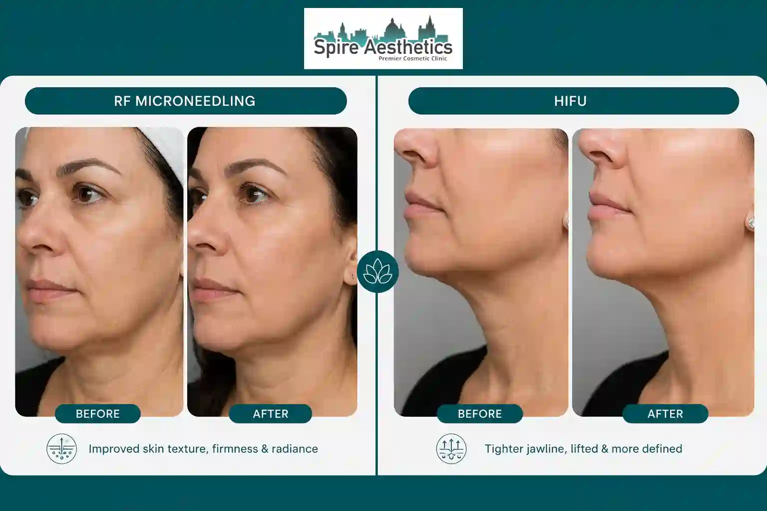 Can RF Microneedling and HIFU Be Combined Southsea?