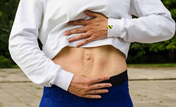 When Could Diastasis Recti Be the Missing Piece of the Puzzle Southsea?