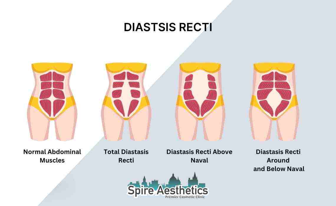 Is Non-Surgical Diastasis Recti Treatment Right for You? Common Concerns Answered Southsea